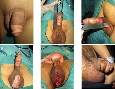 Circumferential full-thickness skin grafting: An excellent method for the treatment of short penile skin in adult men